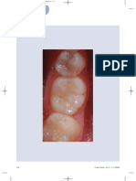 Restoration With Glass Ionomers in Posterior Region Originally Published in Dental Labor