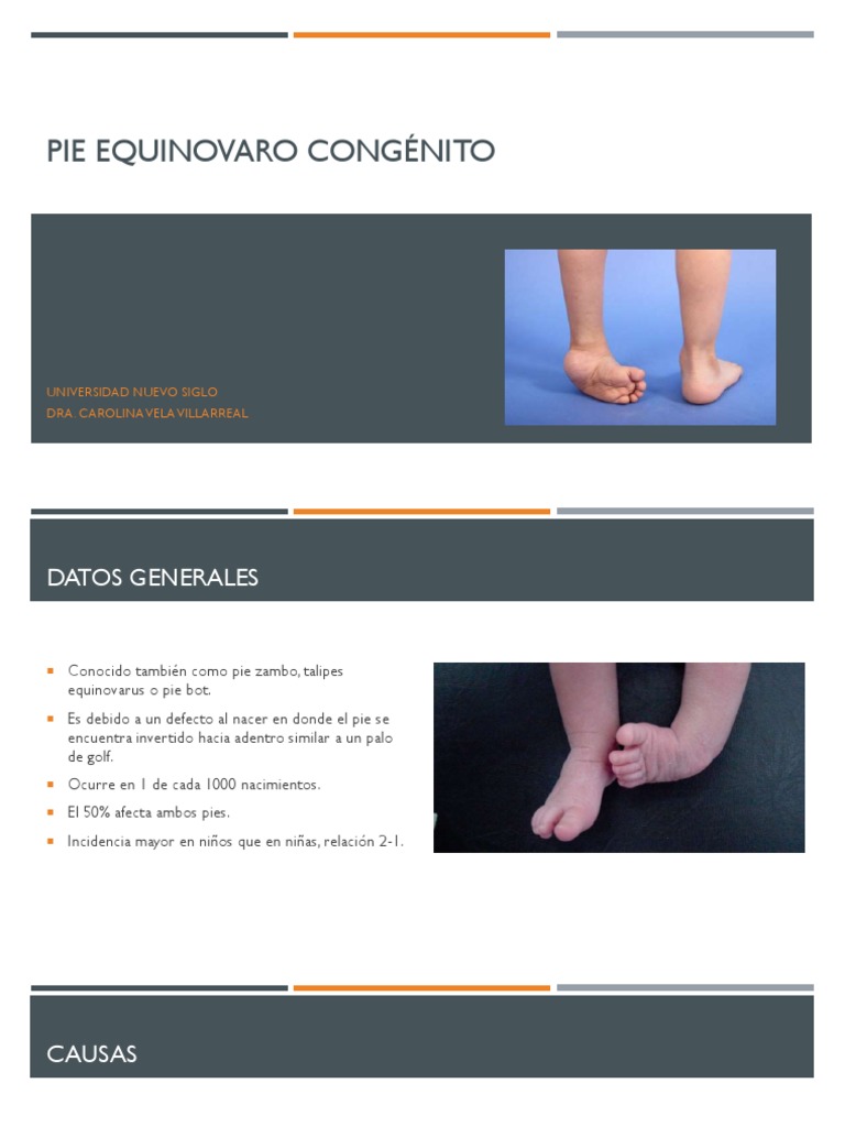 Pie Equino Varo Congénito PDF Pie Especialidades Medicas