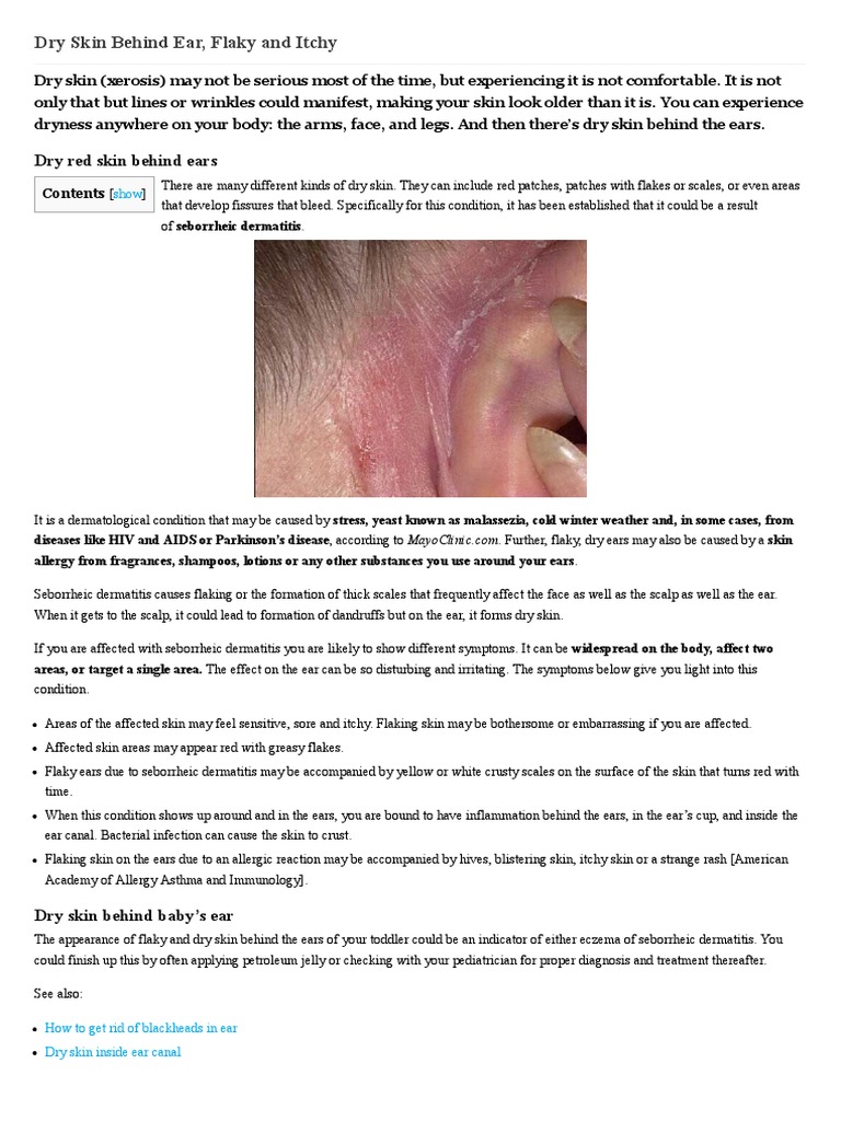 Dry Skin Behind Ear, Flaky, Scaly, Cracked, Baby, Red, Itchy, Skin Rash ...