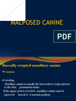 Malposed Canine