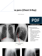 Emfisema Paru (Chest X-Ray)