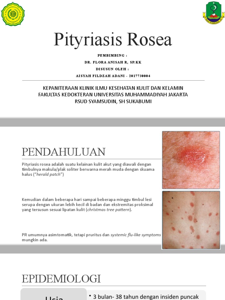 Pityriasis Rosea PDF