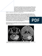 CASO CLÍNICO Hipetecion Endocraneana