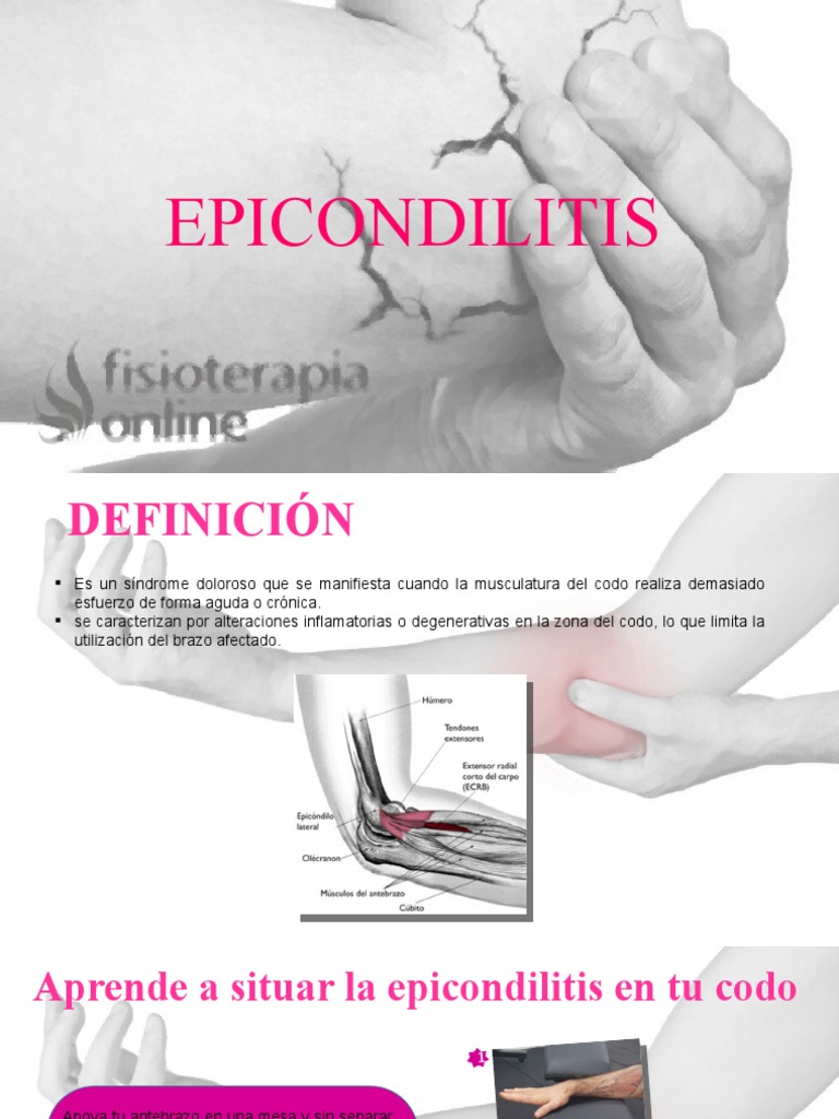 Epicondilitis: Síntomas y Tratamientos | PDF | Diagnostico medico ...