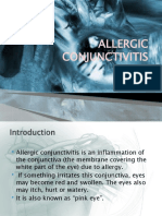 Allergic Conjunctivitis