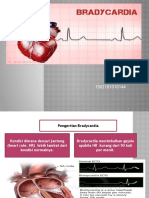 Bradycardia)