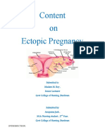 Content On Ectopic Pregnancy