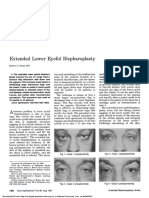 Eyelid Blepharoplasty: Extended