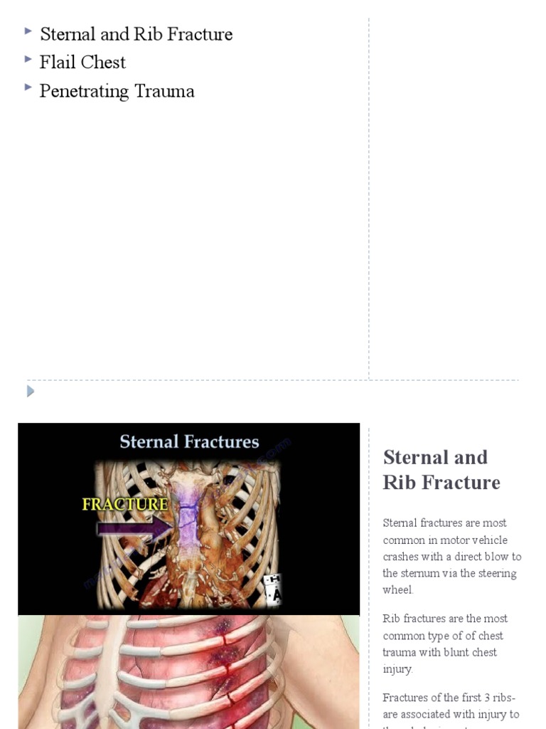 Sternal and Rib Fracture Flail Chest Trauma PDF