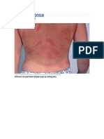 Urticaria Crónica