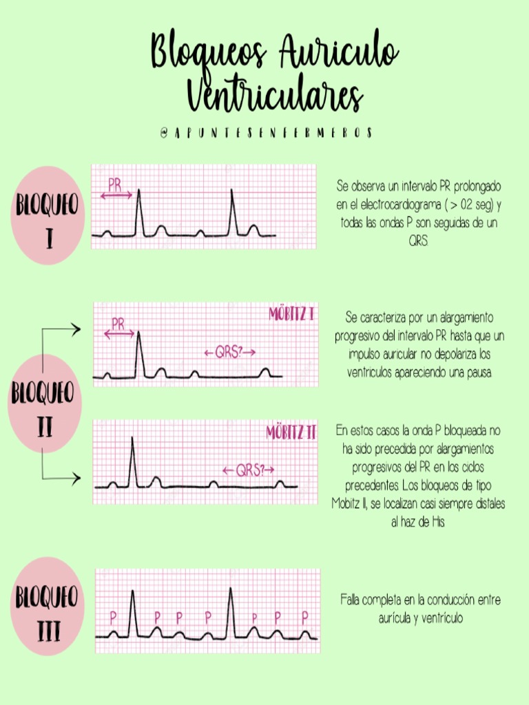 Bloqueo Auriculoventricular @APUNTESENFERMEROS | PDF