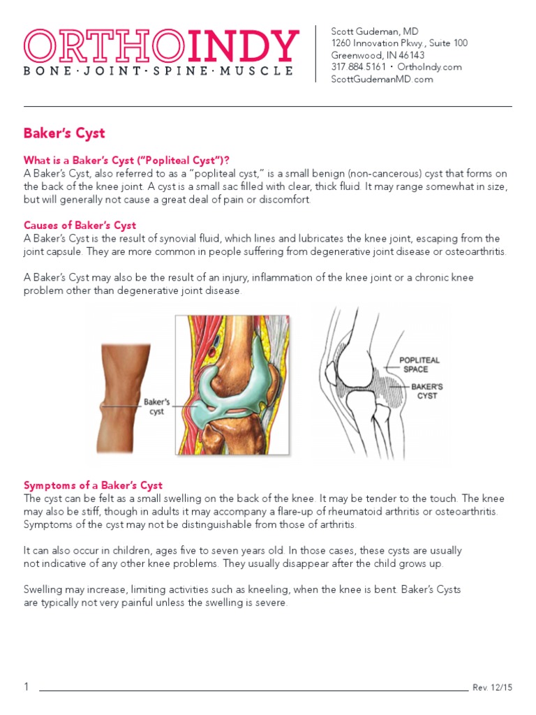 What Is A Baker's Cyst ("Popliteal Cyst") ? PDF Osteoarthritis