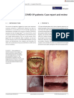 Oral Candidiasis of COVID-19 Patients Case Report and Review