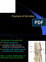 Fracture of The Talus and Calcaneus Nick