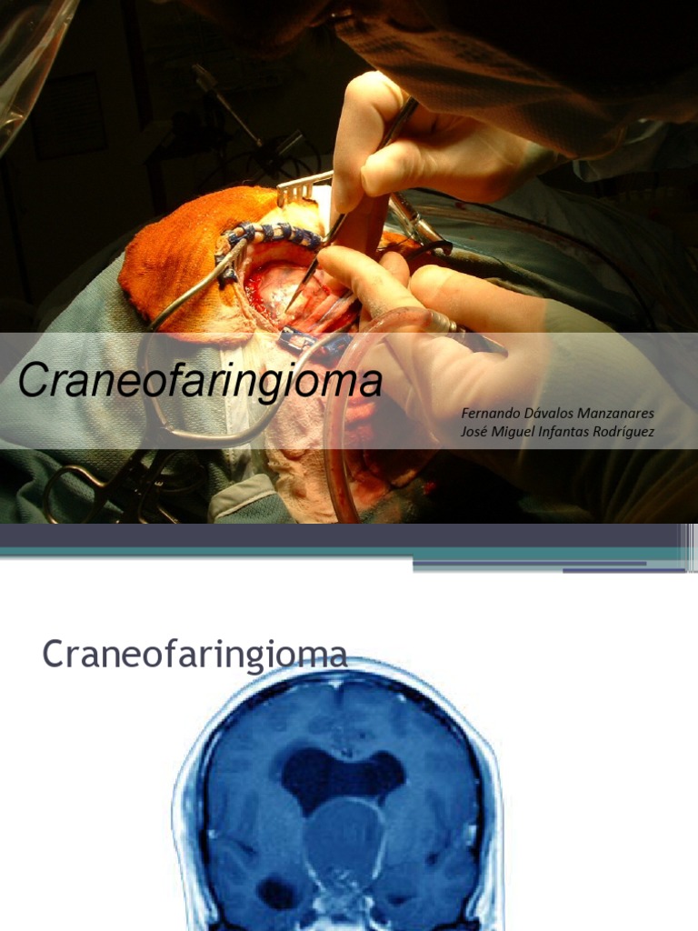 CRANEOFARINGIOMA