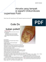 Salinan terjemahan Crusted Scabies Presenting as White Superficial Onychomycosislike Lesion