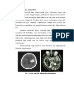 CT-Scan dan MRI untuk Diagnosis Perdarahan Intraserebral