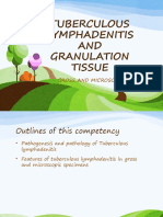 Tuberculous Lymphadenitis AND Granulation Tissue