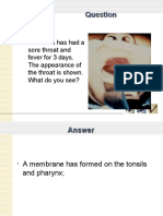 This Child Has Had A Sore Throat and Fever For 3 Days. The Appearance of The Throat Is Shown. What Do You See?
