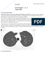 TK: Diagnostyka Dla Pulmonologów - Cz. 2 Zacienienia Typu Mlecznego Szkła