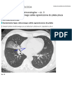 TK: Diagnostyka Dla Pulmonologów - Cz. 3 Zacienienia Typu Mlecznego Szkła Ograniczone Do Płata Płuca