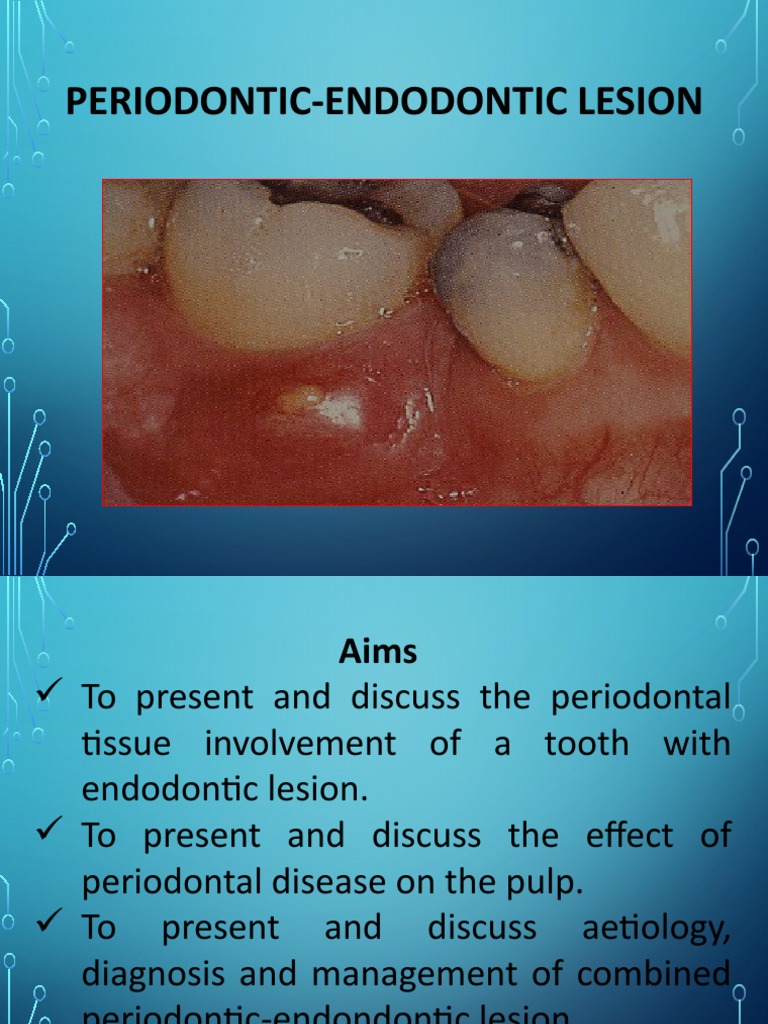 Periodontic Endodontic Lesions PDF Periodontology Human Tooth
