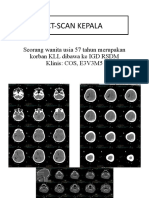 CT-SCAN KEPALA MENDETEKSI SDH DAN EDH