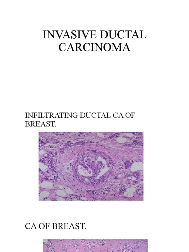 Invasive Ductal Carcinoma | PDF