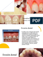 Erosión Dental