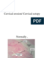 Cervical Erosion