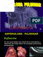 Aspergiloma Pulmonar