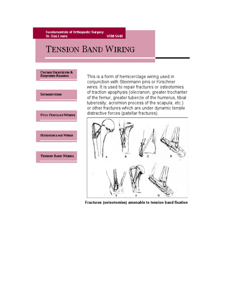 Tension Band Wiring Repair Fractures PDF