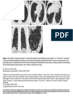 Figure 1. High-Resolution Computed Tomography (CT) Images Demonstrating A Usual Interstitial Pneumonia Pattern. (A-C) Transverse CT Section and