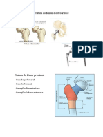 FRATURA DO FEMUR E OSTEOARTROSE