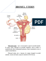 Fibromul Uterin