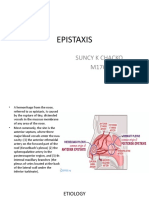 Epistaxis: Suncy K Chacko M1767