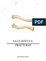 Fractura de Clavicula Original