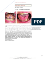 Tongue Necrosis in Giant Cell Arteritis