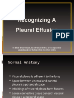 4.pleural Effusion