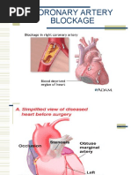 Download CABG Presentation by nmaykanathan SN55798393 doc pdf