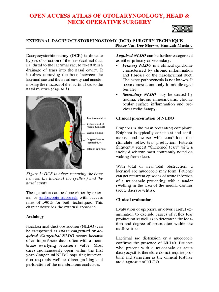 External Dacryocystorhinostomy DCR Surgery Technique PDF Human Nose Clinical Medicine