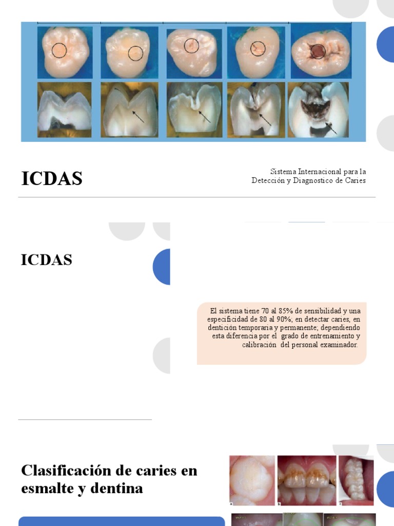 Clasificación ICDAS de Caries Dental | PDF | Diente | Esmalte de dientes