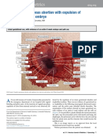 Complete Spontaneous Abortion With Expulsion of An Intact Six-Week Embryo