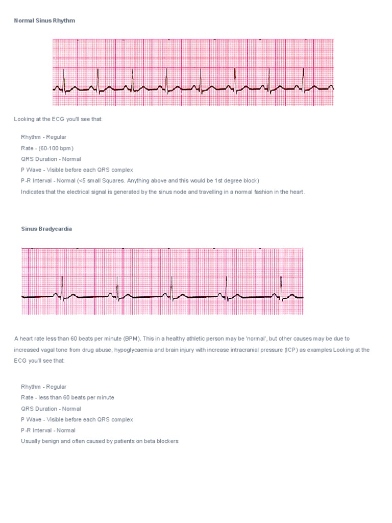 Common ECG Abnormalities Explained | PDF