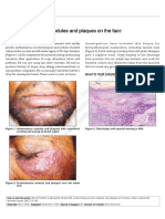 Net Quiz: Ammatory Pruritic Nodules and Plaques On The Fac in Ammatory Pruritic Nodules and Plaques On The Face