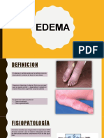 Edema Semiologia