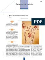 Cardiomyoplastie