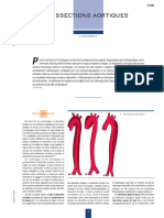 dissections aortiques