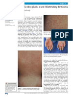 Pityriasis Rubra Pilaris: A Rare Inflammatory Dermatosis: Aine Kelly, Aoife Lally