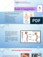 Escoliosis Congénita